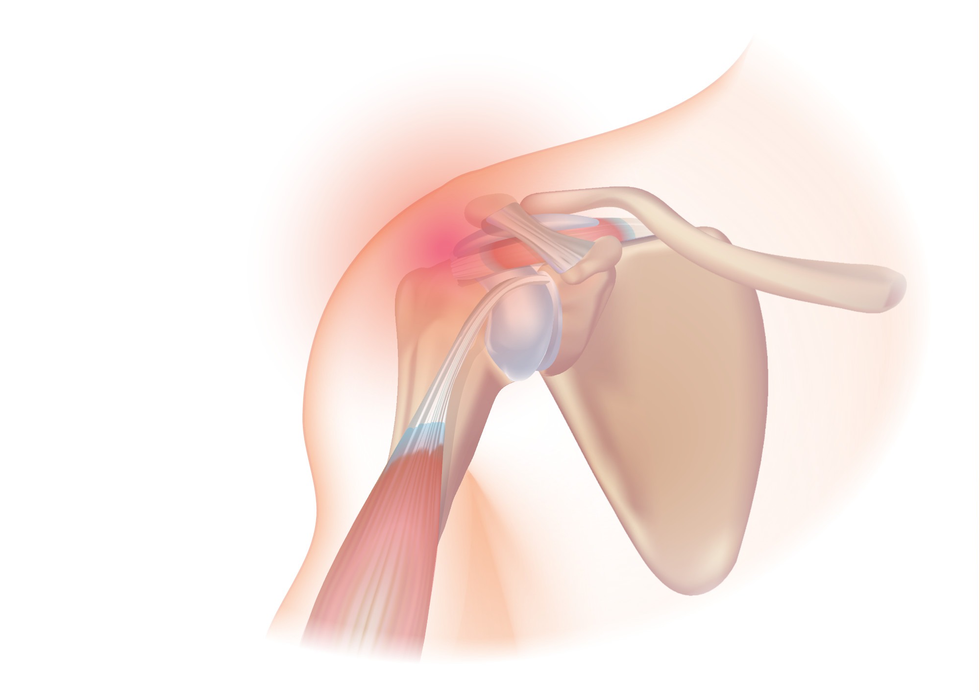Rotator cuff injury’s pain location