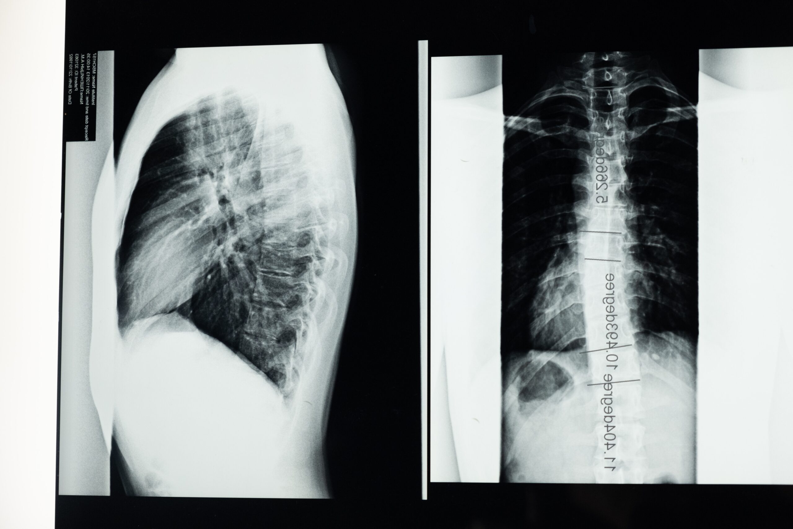 X-ray images of the spine