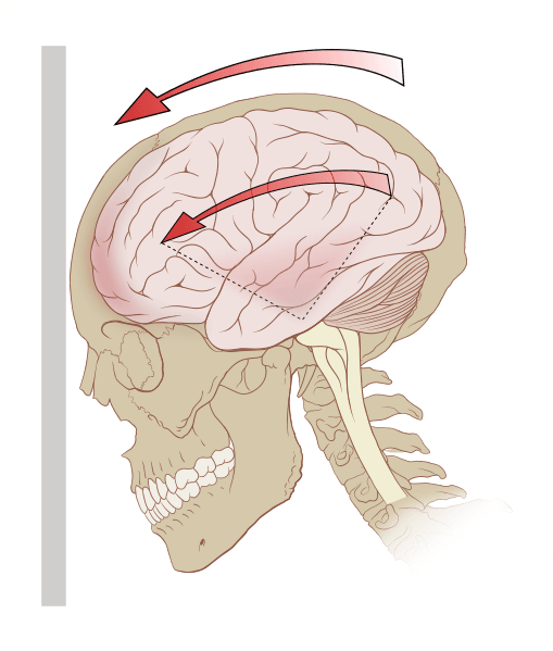 A-diagram-of-the-forces-on-the-brain-in-concussion