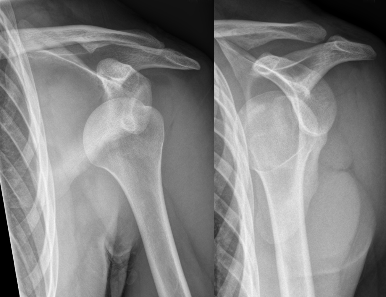 Anterior dislocation of the left shoulder